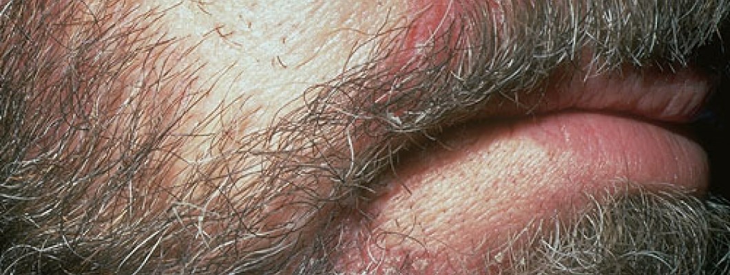 RÂU BỊ GÀU KHÔ DA LỜI KHUYÊN VÀ CÁCH KHẮC PHỤC