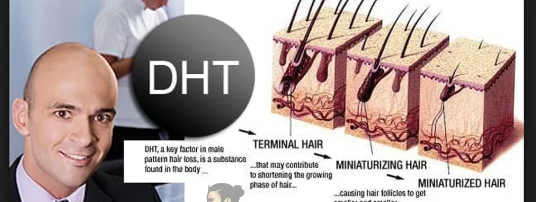 DHT Là Gì? DHT Ảnh Hưởng Đến Tóc Như Thế Nào?