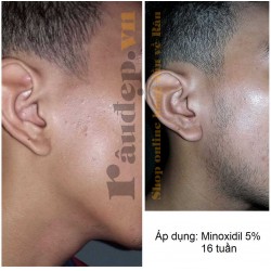 Dung Dịch Mọc Râu Kirkland Minoxidil 5% Dạng Lỏng - Nam