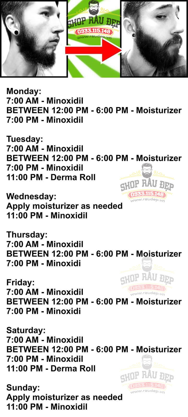 Lịch trình kết hợp lăn kim và Minoxidil