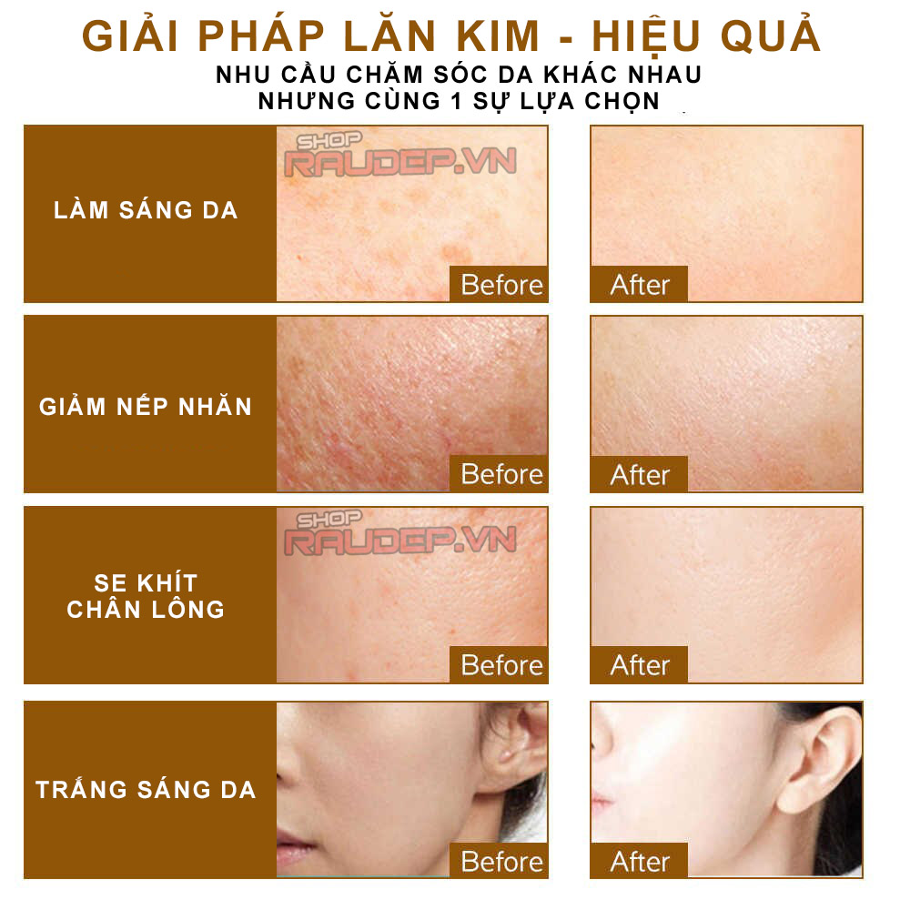 Lăn kim ZGTS 0.5mm kích thích nang lông