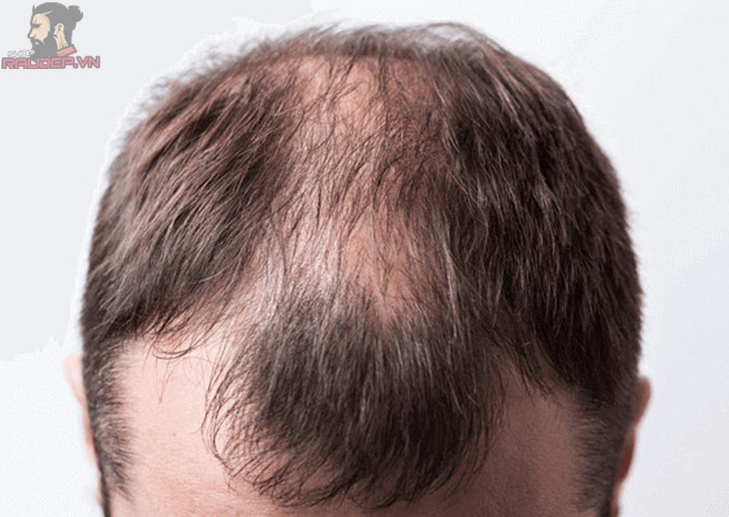 Rụng tóc là gì 15 nguyên nhân và dấu hiệu thường gặp