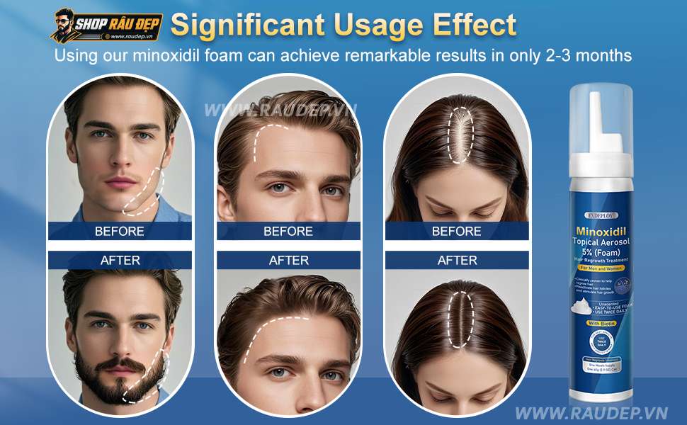 Hướng dẫn sử dụng Exdeploy Minoxidil Foam 5%